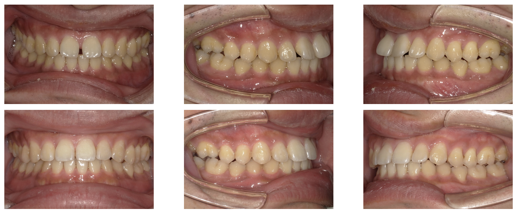部分矯正の歯科矯正治療例 - 千葉駅から直結 千葉センシティ矯正歯科