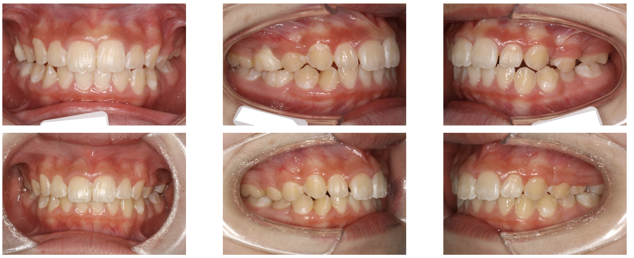 すきっ歯の小児矯正治療例 - 千葉駅から直結 千葉センシティ矯正歯科